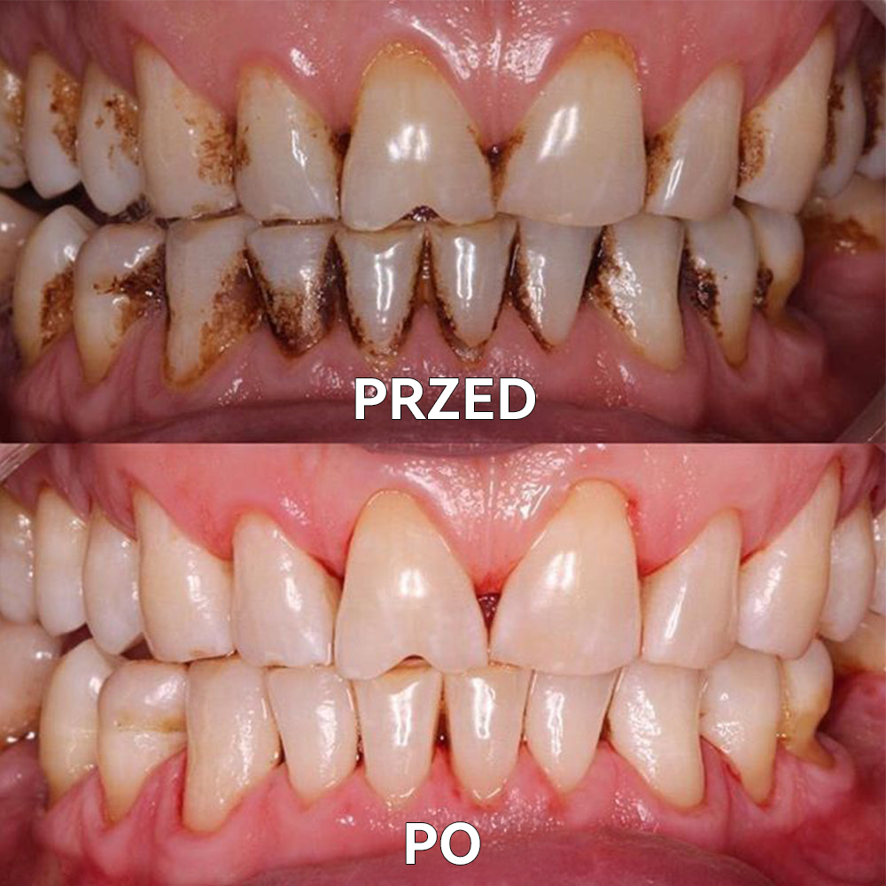 🟣Ourlyard™ Proszek mineralny do regeneracji zębów 🔥Kompleksowa pielęgnacja: naprawa, wybielanie, zdrowe dziąsła i świeży uśmiech