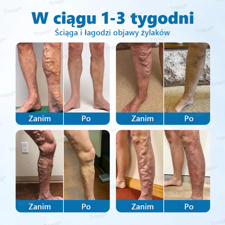 💙💙Trimil® Ziołowy Spray na Ochronę Żył - ✅ Klinicznie udowodniono, że eliminuje żylaki w zaledwie 7 dni!