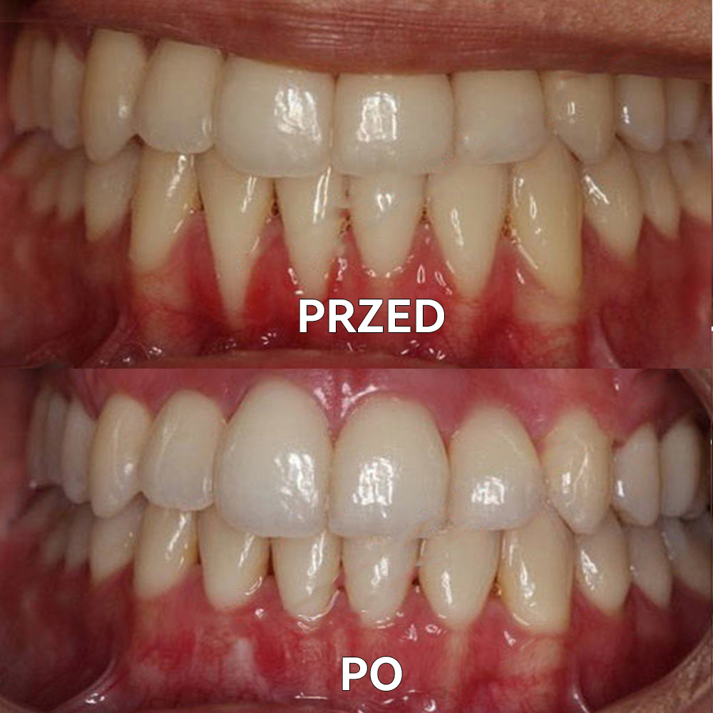 🟣Ourlyard™ Proszek mineralny do regeneracji zębów 🔥Kompleksowa pielęgnacja: naprawa, wybielanie, zdrowe dziąsła i świeży uśmiech