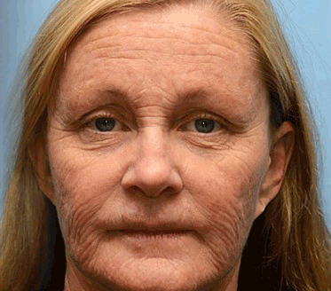 💛FrissArc™ Botox Miód Pszczelego Krem przeciwzmarszczkowy - Redukuje zmarszczki, ujędrnia skórę i rozjaśnia cerę ( Przeciwstarzeniowy krem o podwójnym działaniu )